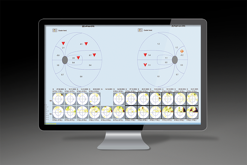 EYESUITE 青光眼分析